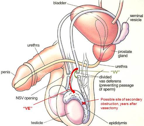 Vasweb Com Dr Doug Stein Florida Vasectomies And Reversals